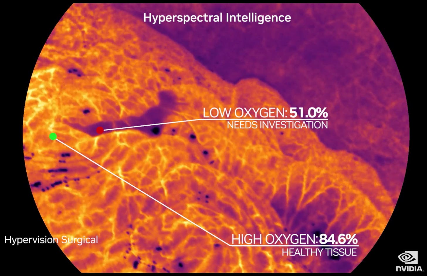 King's surgical AI spin-out Hypervision Surgical secures £6.5M seed investment